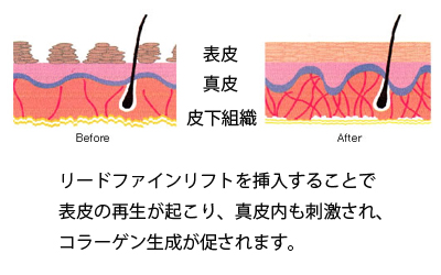 リードファインリフト解説図