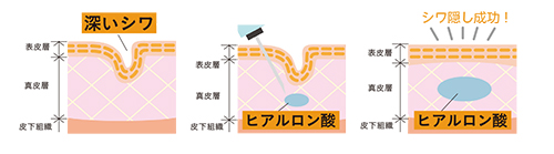 ヒアルロン酸解説