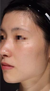 フォトフェイシャル Ipl の効果や口コミ情報 副作用は アリュクス