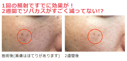 【フォトフェイシャルM22】1クール(5回)の治療でシミ・ソバカスはどこまで薄くなるのか検証!