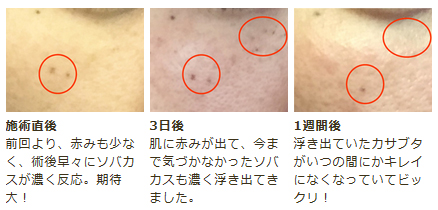 【フォトフェイシャルM22】1クール(5回)の治療でシミ・ソバカスはどこまで薄くなるのか検証!