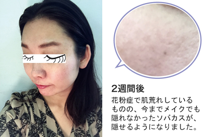 【フォトフェイシャルM22】1クール(5回)の治療でシミ・ソバカスはどこまで薄くなるのか検証!