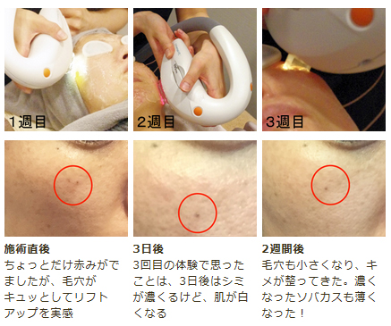 【フォトフェイシャルM22】1クール(5回)の治療でシミ・ソバカスはどこまで薄くなるのか検証!