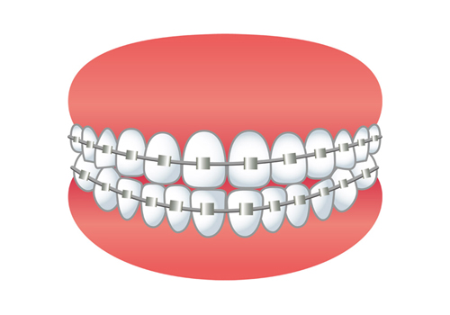 選んだ歯列矯正は、金属ブラケット