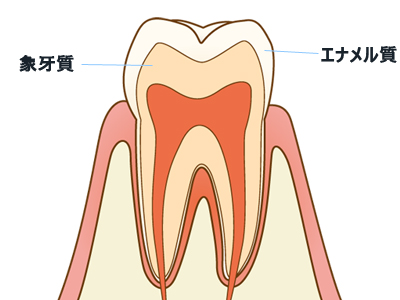 酸蝕歯が起きるメカニズム