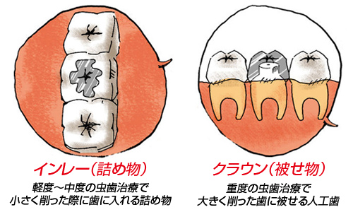 人工歯の形状は主に2種類！